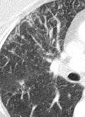 IMAGING: Beaded, nodular, or smooth interlobular septal thickening +/- Thickening of bronchovascular bundles No distortion of lung parenchyma +/- Lymphadenopathy (50%)