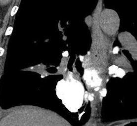 Chest CT: Large metastatic pulmonary nodules with mucoid calcification.