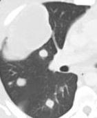 cysts, +/- small nodules Lymphocytic interstitial pneumonia +/- Ground glass opacities and centrilobular nodules