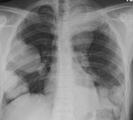 in number 30-year-old male with hemoptysis. Multiple bilateral masses on chest radiograph.