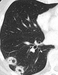 DDX: Primary lung malignancy Overall more common to be cavitary than a metastasis Single lesion with a thick and sometimes nodular wall +/- Regional lymphadenopathy Septic emboli