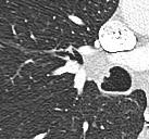 IMAGING: Endobronchial nodule or mass Post obstructive