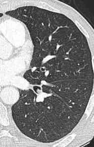 subsequent CT Carcinoid +/- Calcifications Hypervascular