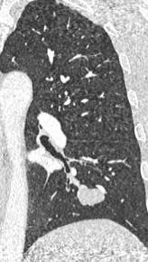 Chest CT: bilateral bronchial wall thickening, bronchial