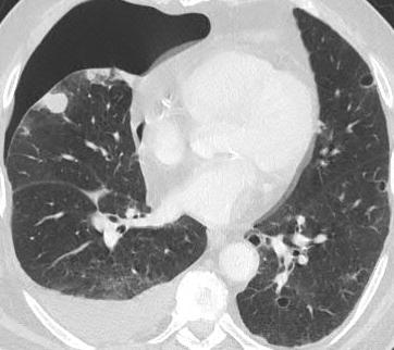 POSSIBLE PATHOPHYSIOLOGIC MECHANISMS: 1. Necrosis and/or rupture of a peripheral cavitary/cystic metastasis with involvement of the pleura, thus creating a bronchopleural fistula 2.
