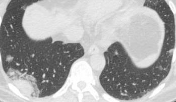 PATHOPHYSIOLOGY: Tumor cells spread along intact alveolar walls Tumor utilizes lung parenchyma as a scaffold without causing architectural distortion MOST COMMON PRIMARIES: