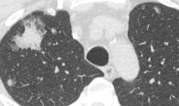 opacities Halo sign DDX: Pneumonia Angioinvasive aspergillosis Granulomatosis with polyangiitis Tuberculosis Pulmonary adenocarcinoma 57-year-old male with pancreatic