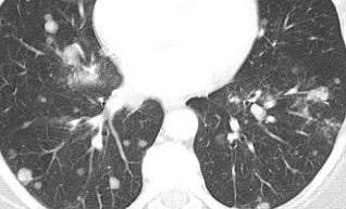 Innumerable spherical lower/mid lung predominant solid pulmonary metastases.