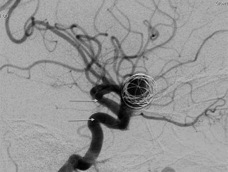B Lateral projection of arterial phase angiogram obtained just after 3D coil detechement and flow diverter deployment (arrows).