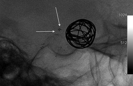 Initial experience with implantation of novel dual layer flow-diverter device FRED In our series Fred demonstrated 100% aneurysm occlusion.