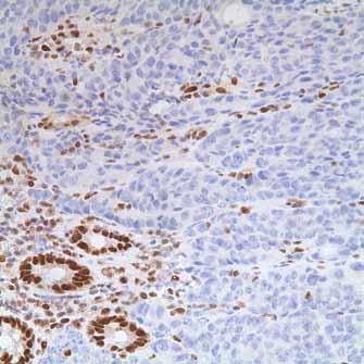 Journal of Gastrointestinal Oncology, Vol 3, No 3 September 2012 167 Table 3 Immunohistochemical staining