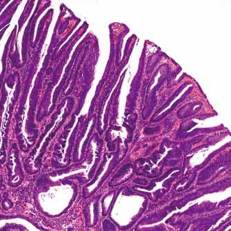 Serrated polyps Serrated polyp is a general term for any polyp that shows a serrated (sawtooth or stellate) architecture of the epithelial compartment.