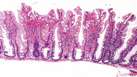 160 Fleming et al. Pathologic aspects of colorectal carcinoma A B Figure 11 Low power (A. original magnification 40) and high power (B. original magnification 200) views of sessile serrated polyp.