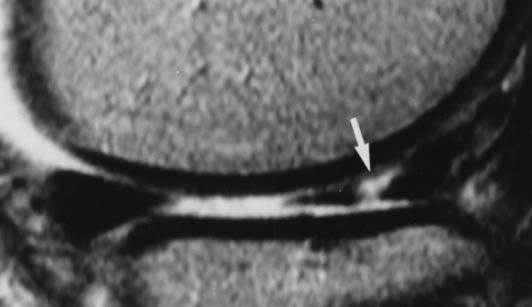 MR Imaging of Knee Meniscus s Fig. 3. 52-year-old man with right knee pain.