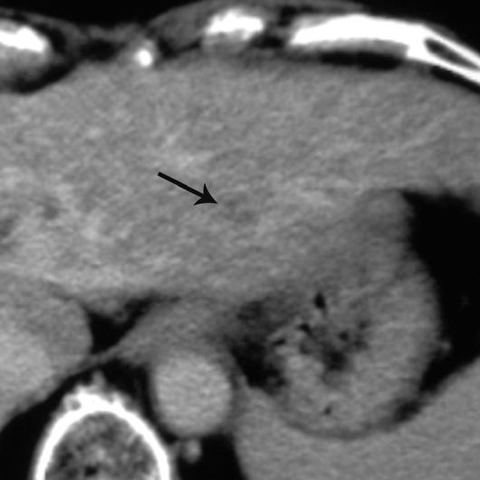 19 hypoattenuating lesions before the emergence of attenuation conversion on follow-up CT.