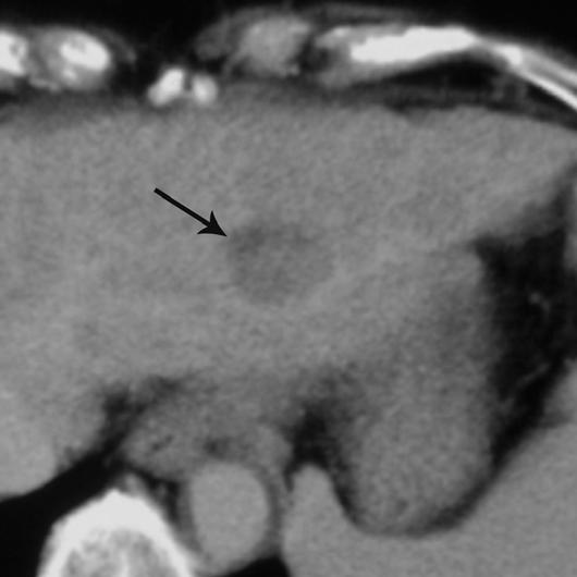 A, Arterial phase CT scan shows 1.0-cm hypoattenuating lesion (arrow) in segment II of liver.