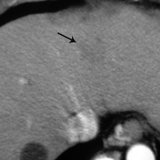 C, Arterial phase of last CT scan 3 years 10 months after A shows hypoattenuating lesion (arrow) has grown to 2.5 cm.