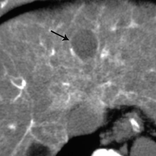 CT in Liver Disease Fig. 2 (continued) 57-year-old man with hypoattenuating lesion and no change in attenuation even with increase in tumor size (group A, unchanged type).