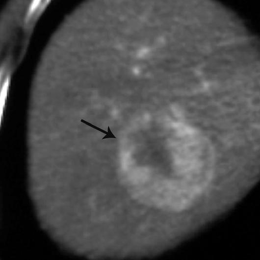 8-cm lesion (arrow) in segment VII that was also hypoattenuating in delayed phase (not shown).
