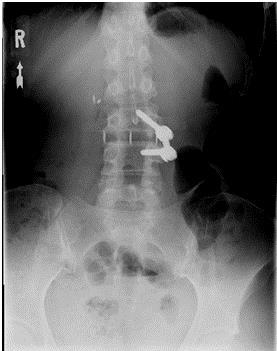 The patient underwent an XLIF at L3-L4 with