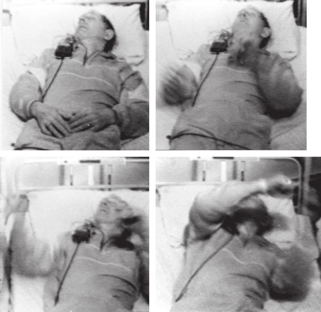 Chapter 3: Multiple system atrophy 35 A B C D Figure 3.5 REM sleep behavior disorder during polysomnography in a patient with multiple system atrophy of the parkinsonian type.