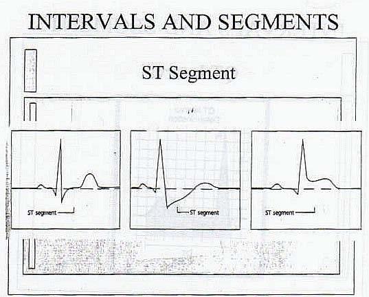 ST depression: The ST segment falls below the baseline for.