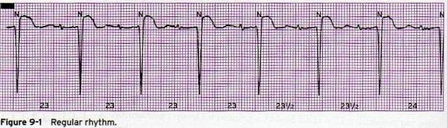 RHYTHM REGULARITY Rhythm Regularity: Refers to the regularity of the QRS complexes Measure