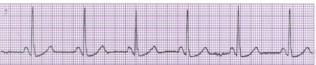 MEASUREMENT OF HEART RATE 6 seconds 3 seconds 1 2 3 4 5 6 6 SECOND METHOD To determine HR: There are small line markers on the top of the graph paper