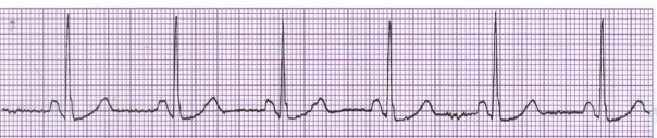 MEASUREMENT OF HEART RATE How to calculate the heart rate on ECG paper 300 150 100 75 6050 43 37 3330 1 big box BIG