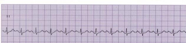 Sinus Tachycardia Sinoatrial node Rhythm Rate P Wave PRI QRS (per minute) Regular 100-160 Upright Uniform 0.12-0.
