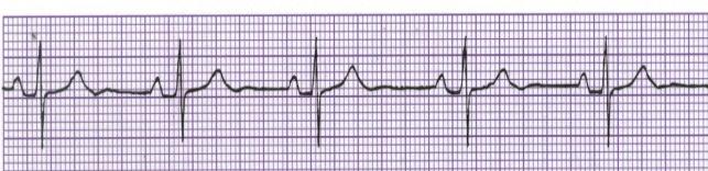 Sinus Bradycardia Sinoatrial node Rhythm Regular Rate (per minute) 40-60 P Wave Upright Uniform PRI 0.12-0.20 QRS 0.06-0.