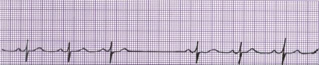 Sinoatrial (SA) Block Rhythm Rate P Wave PRI QRS (per minute) Regular but interrupted Usually 60-100 Upright, uniform but entire cycle missing 0.12 0.20 <0.
