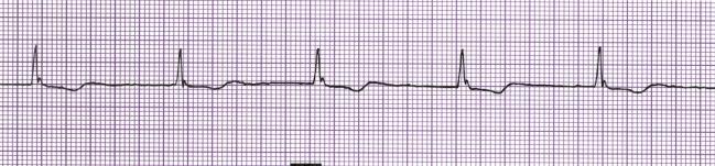 Premature Junctional Contractions (PJC) Rhythm Rate (per minute) P Wave PRI QRS Regular but interrupted Occurs at any rate Inverted before or after QRS or not visible <0.12 if P precedes QRS <0.