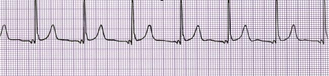 Accelerated Junctional AV node Rhythm Regular Rate (per minute) 60-100 P Wave If visible, inverted (before or after QRS) Causes
