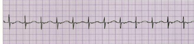12 Junctional Tachycardia Rhythm Rate (per minute) P Wave PRI QRS Regular >100 If visible, inverted (before or after QRS) If able