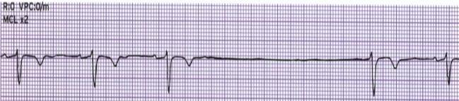 Junctional Escape Rhythm Rhythm Regular Irregular Rate (per minute) 40-60 P Wave If present inverted before or after