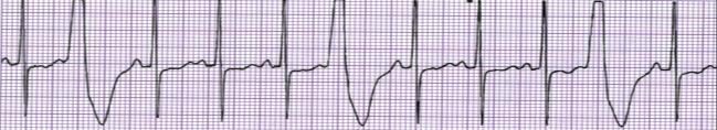 Premature Ventricular Contraction Rhythm Rate (per minute) P Wave PRI QRS T wave Regular but interrupted by PVC s Occurs at any rate Not seen on PVC s N/A >0.