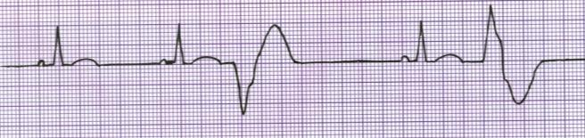 minute) P Wave PR Interval QRS Usually