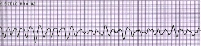 Ventricular Fibrillation (VF) Rhythm Rate (per minute) P Wave PR Interval QRS Not detectable Can t be counted None Causes Significant