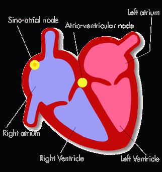 Heart Blocks 1. What is heart block? Heart block is an arrhythmia usually caused by ischemia or an MI.