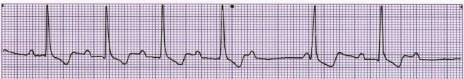 Treat the cause 2 nd Degree Heart Block Type I - Wenckebach Rhythm Rate P Wave PRI QRS (per minute) Usually irregular Atrial usually 60-100 Ventricular < atrial Sinus P s Gradually # s