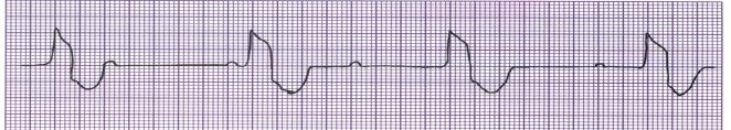 2 nd Degree Heart Block Type II Rhythm Regular Or Irregular Rate (per minute) Atrial usually 60-100 Ventricular < atrial P Wave Sinus P s 2 or > before each QRS PRI Constant for conducted beats QRS