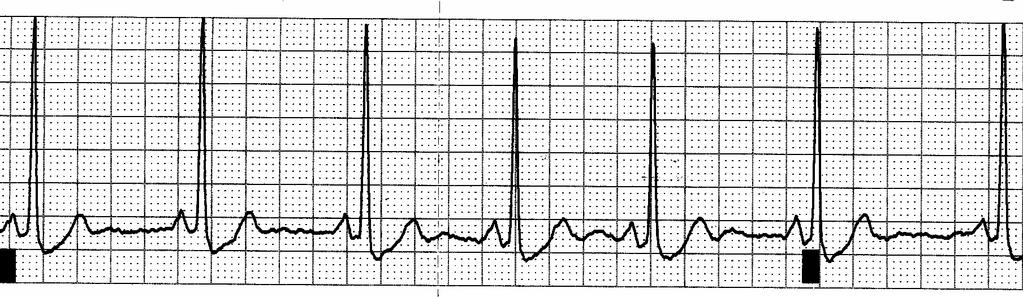Rate: Atrial 40 Ventricular 40 Regular? Yes P waves _Yes-all the same Followed by QRS? Yes PRI 0.16 QRS 0.