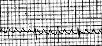 Rate: Atrial 300 Ventricular 80 Regular? No P waves f waves Followed by QRS? sometimes PRI _not measured QRS 0.