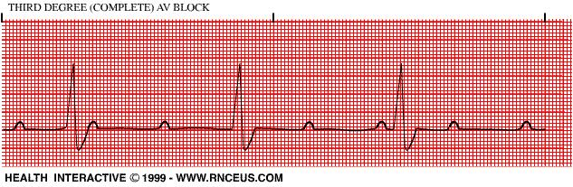 Rate: Atrial 80 Ventricular 60 Regular? No P waves _yes-all the same Followed by QRS?_not all PRI _0.16-0.32 prolonging QRS 0.