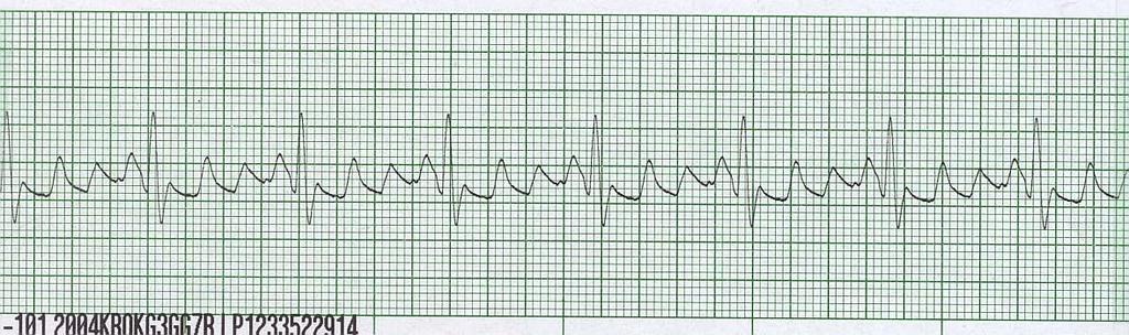 Marks 1. What is the ventricular rate? Is it regular? Are there any premature QRS s? Ask yourself -Are the premature QRSs wide or narrow? 2. P waves What is the rate? Are the each followed by a QRS?