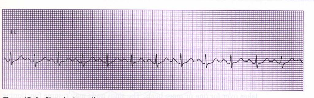 Mark /10 1. What is the ventricular rate? Is it regular? Are there any premature QRS s? Ask yourself- Are the premature QRS s wide or narrow? 2. P waves What is the rate?