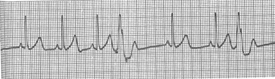 Marks 1. What is the ventricular rate? Is it regular? Are there any premature QRS s? Ask yourself- Are the premature QRS s wide or narrow? 2. P waves What is the rate? Are the each followed by a QRS?