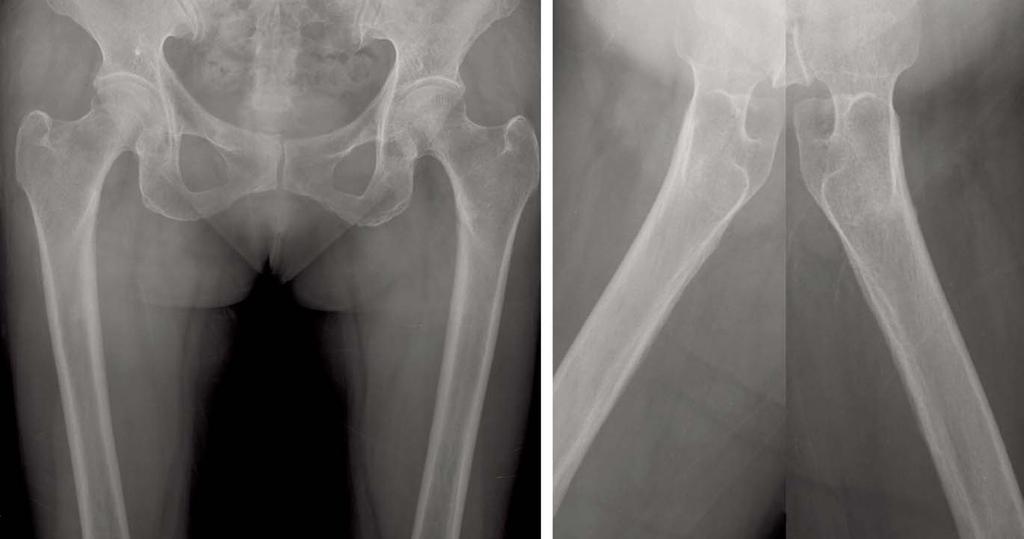 Dong-Sik Chae et al.: Bilateral Insufficiency Fracture of Medial Subtrochanteric Area of the Femur: A Case Report medial side of the femur.