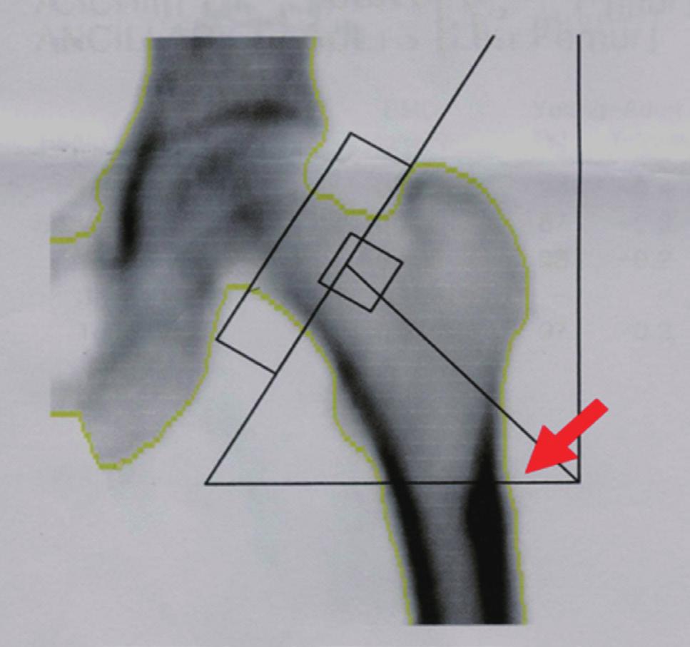 Kyu Hyun Yang, et al. Left femur bone density Fig. 3. Dual energy X-ray absorptiometry (DXA) image of the hip joint sometimes depicts periosteal callus (arrow) in the lateral femoral cortex.